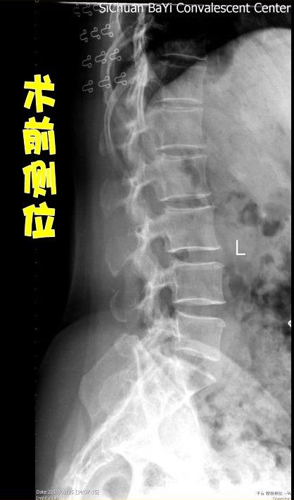 腰椎間盤突出伴腰椎不穩