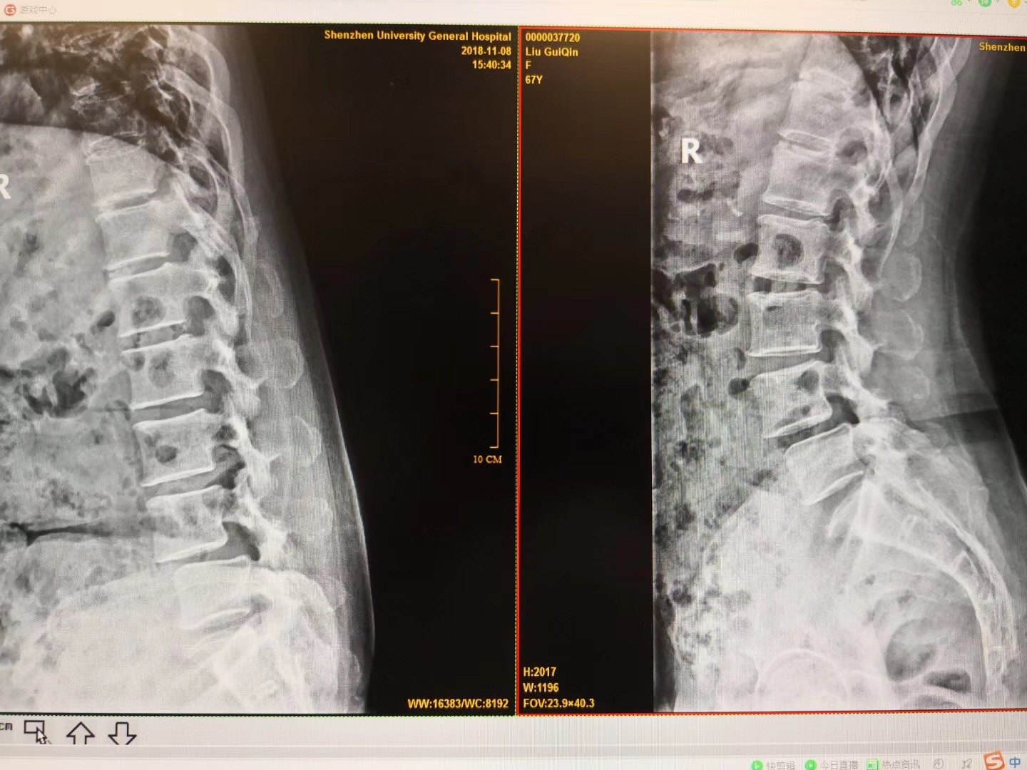 腰椎管狭窄,椎体滑脱案例解析