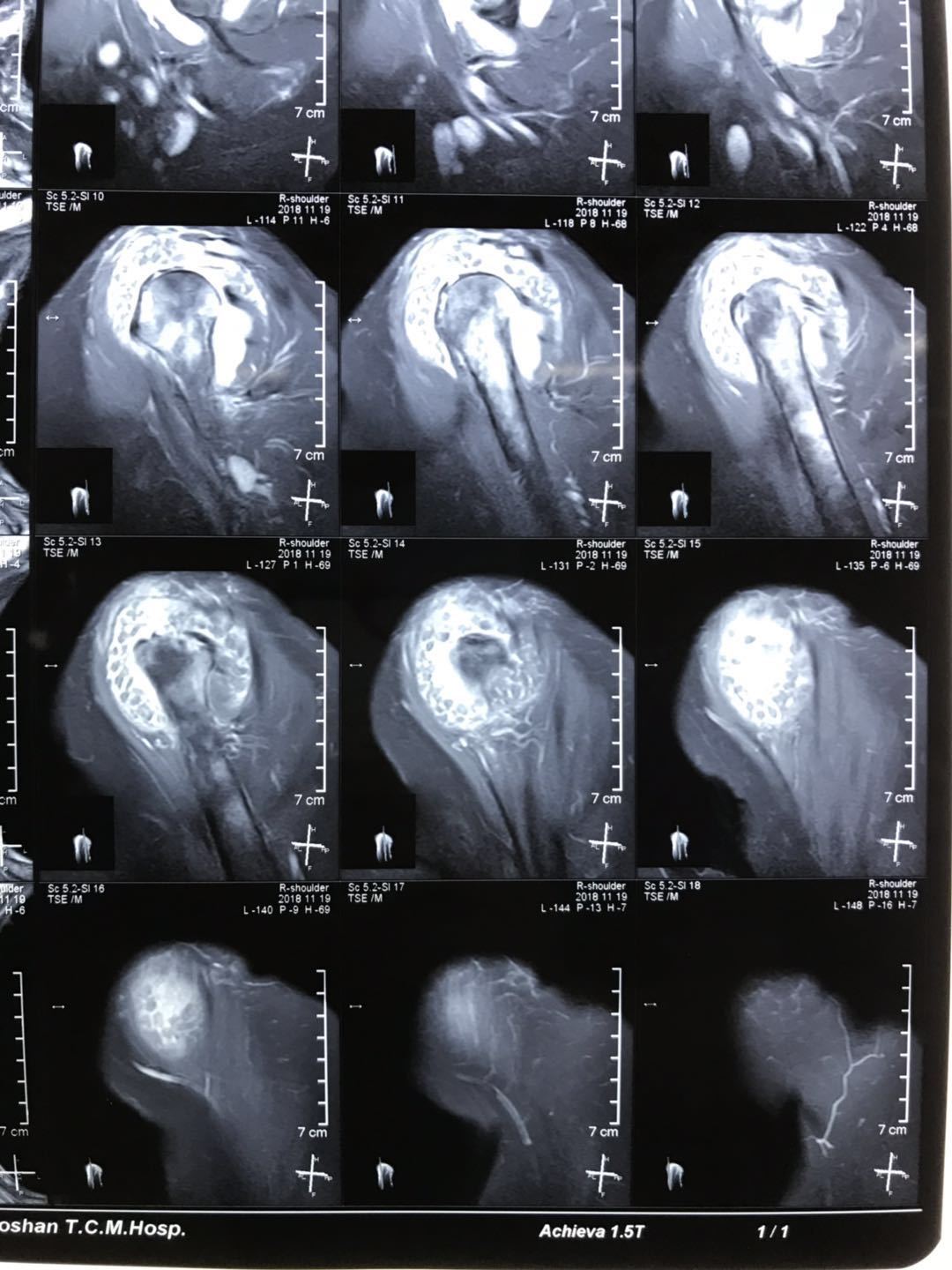 严重的肩关节 滑膜软骨瘤病 一例 - 好大夫在线