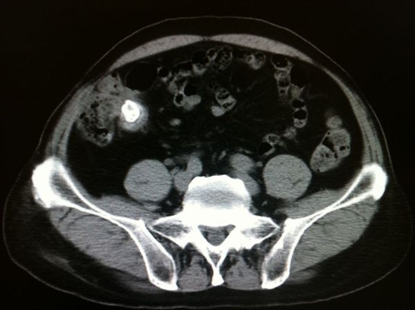 阑尾切除术后20年,阑尾残端粪石形成