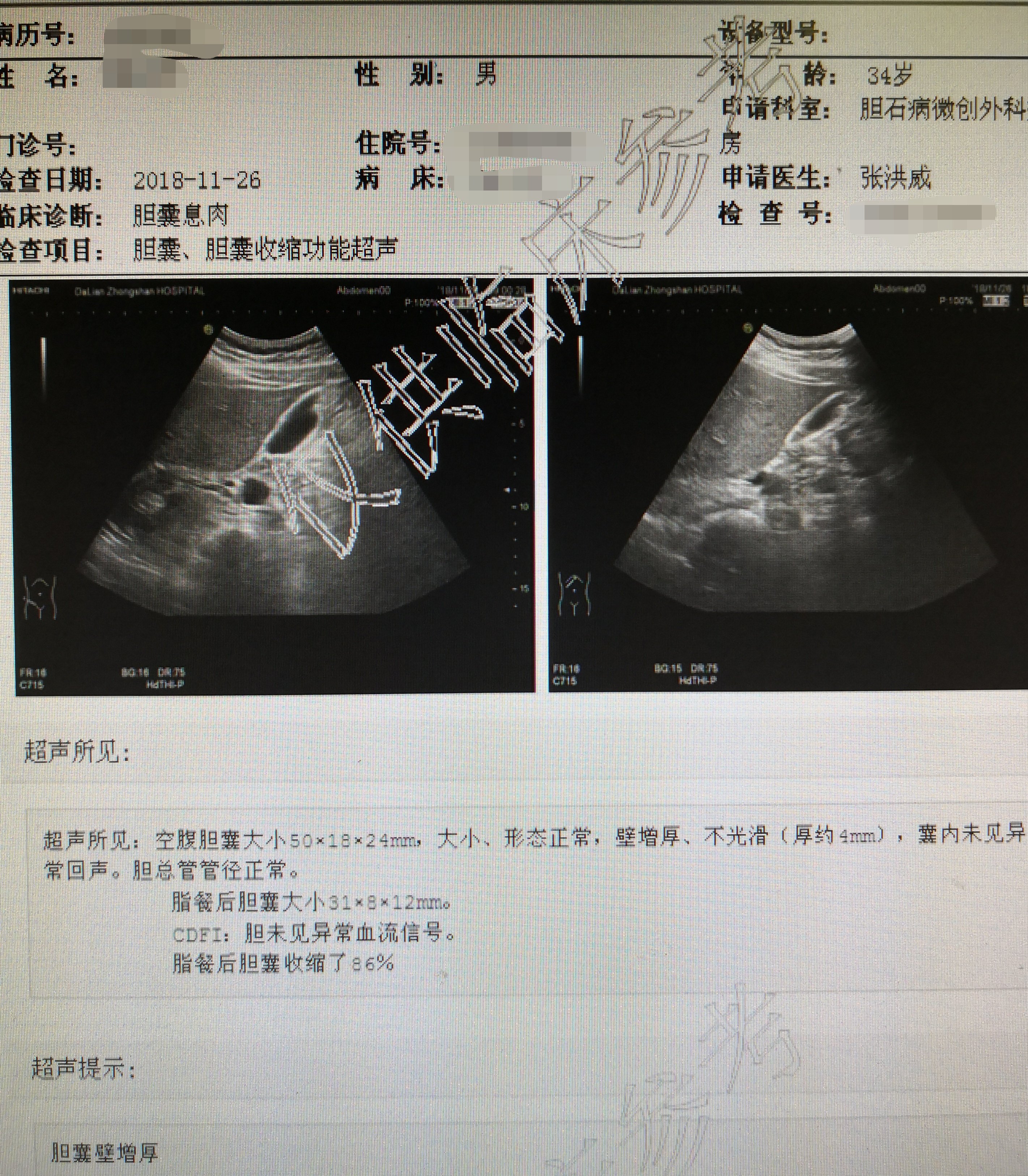 保胆取息肉术微创治疗胆囊良性息肉