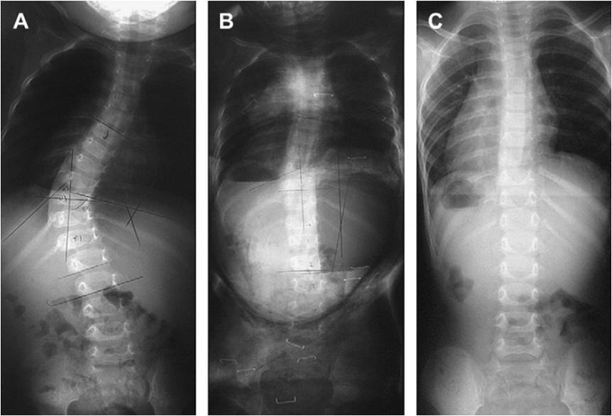 孩子发现脊柱侧弯该如何治疗