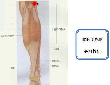 腓肠肌外侧头附着处痛点.jpg