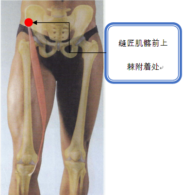 缝匠肌髂前上棘附着处痛点.png