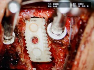 切除颈椎间盘的空隙放入融合器.
