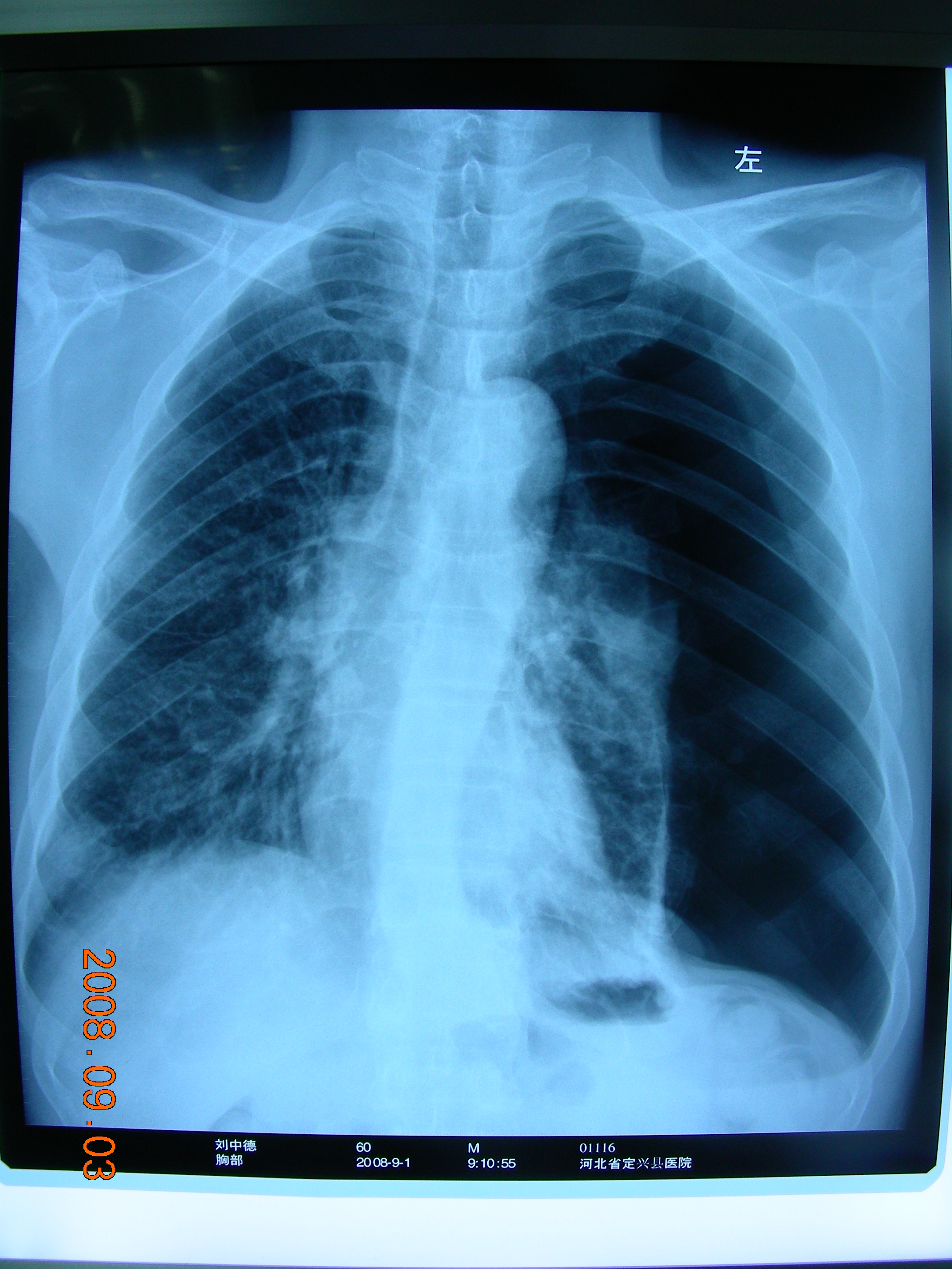 气胸及肺大疱的微创手术治疗