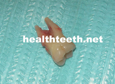 各种牙齿劈裂的图片 - 好大夫在线