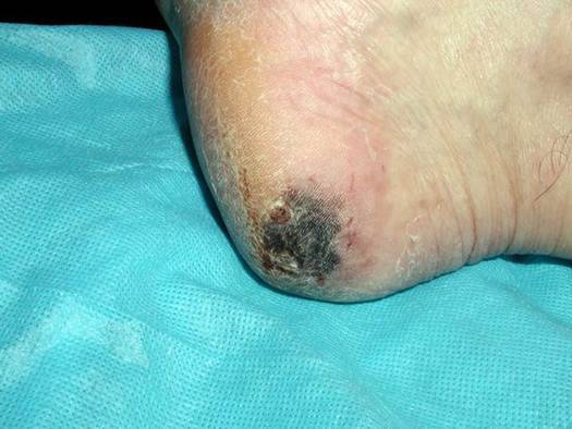 白人高发浅表扩散型黑色素瘤在黄种人少见,肢端雀斑样黑色素瘤约占