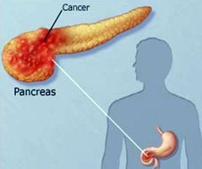 胰头癌示意图图片