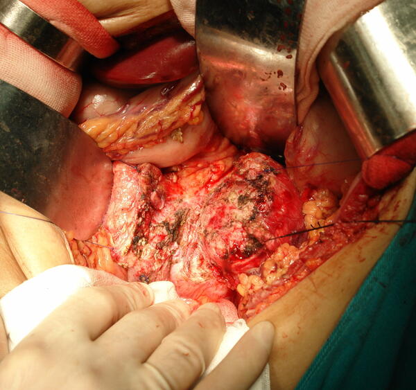 胰头癌手术图片