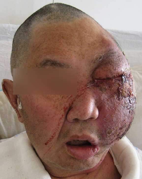 面部疖肿并发腐败坏死性蜂窝组织炎的治疗