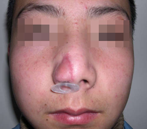 面瘫修复眶距增宽矫形上睑下垂修复鼻翼缺损畸形应用整形外科原则修复