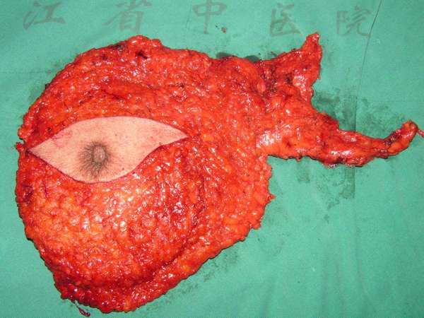 乳腺癌清扫淋巴结数目问题 - 好大夫在线 ·智慧互联网医院