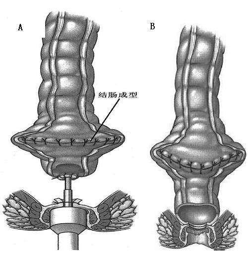 附图3 结肠纵切横缝"《》"型成型手术后(a)与直肠超低位缝合(b),排便