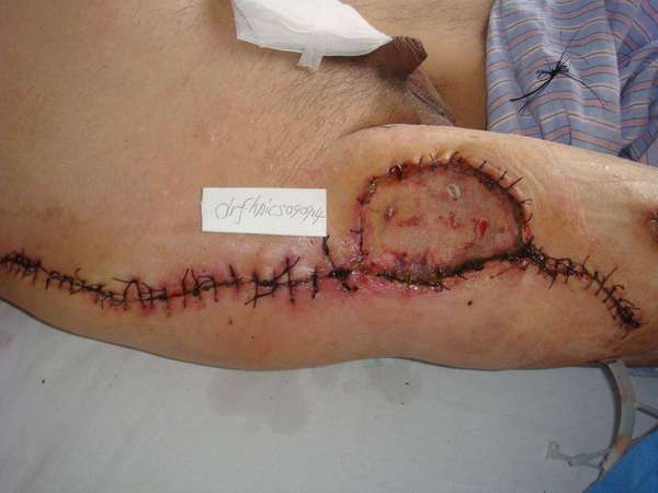 右股外侧巨大隆突性皮纤维肉瘤 较为罕见 广切植皮 全部存活 康复出院