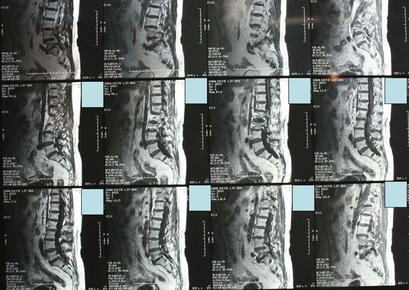 仔細閱讀腰椎mri發現l5-s1椎間盤左後突與患者病變側及症狀相符,且l5