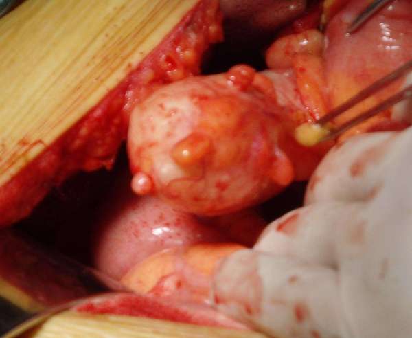 阑尾也可以长肿瘤吗