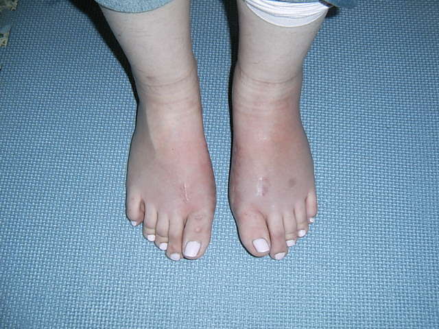 拇外翻(大脚骨,大骨拐)