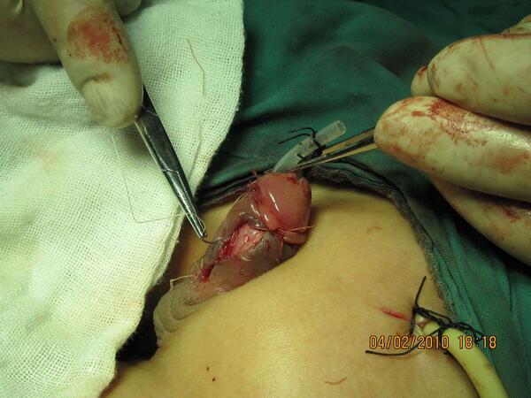尿道下裂手术后尿漏图图片