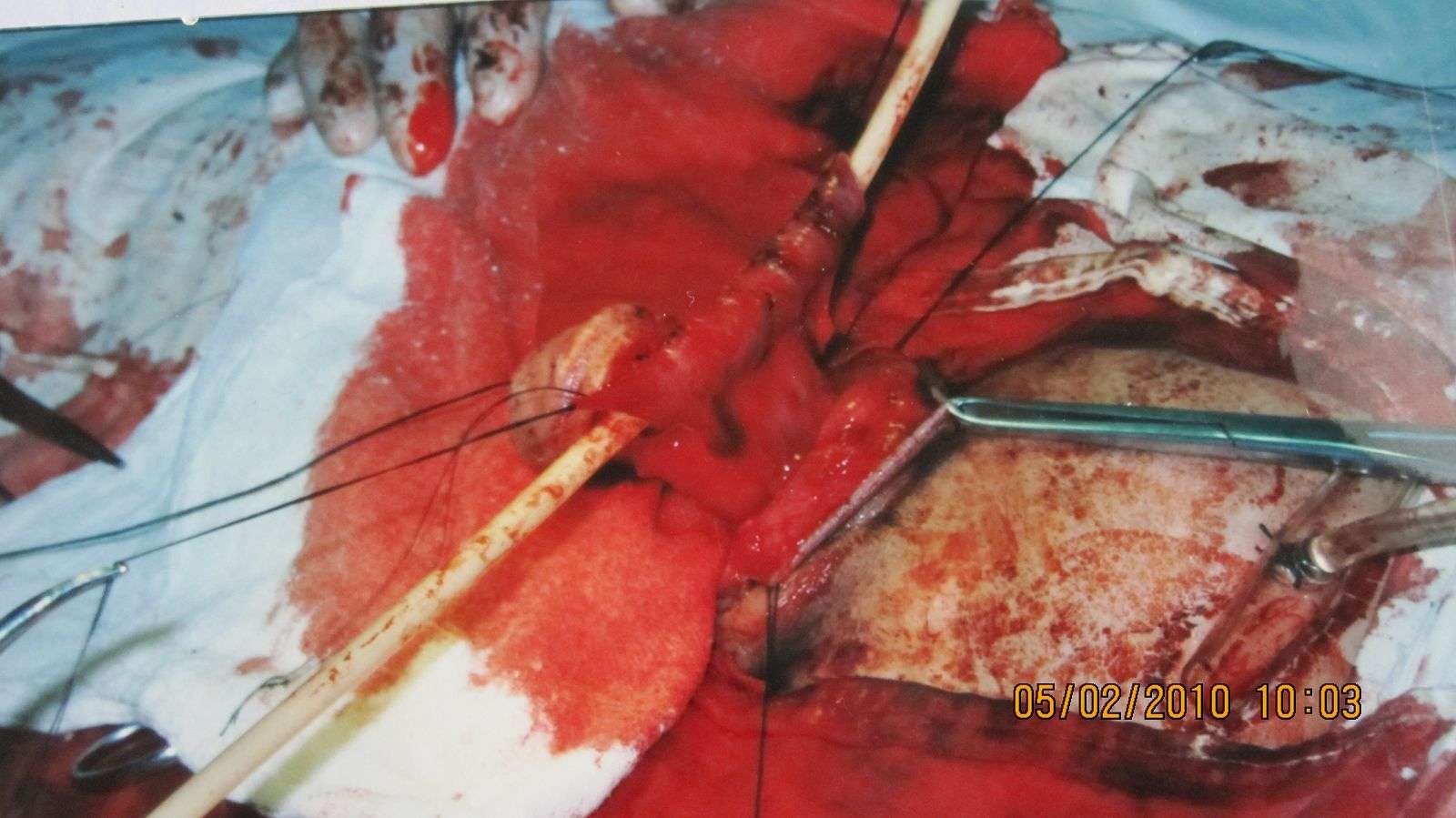 女宝宝尿道下裂手术图片