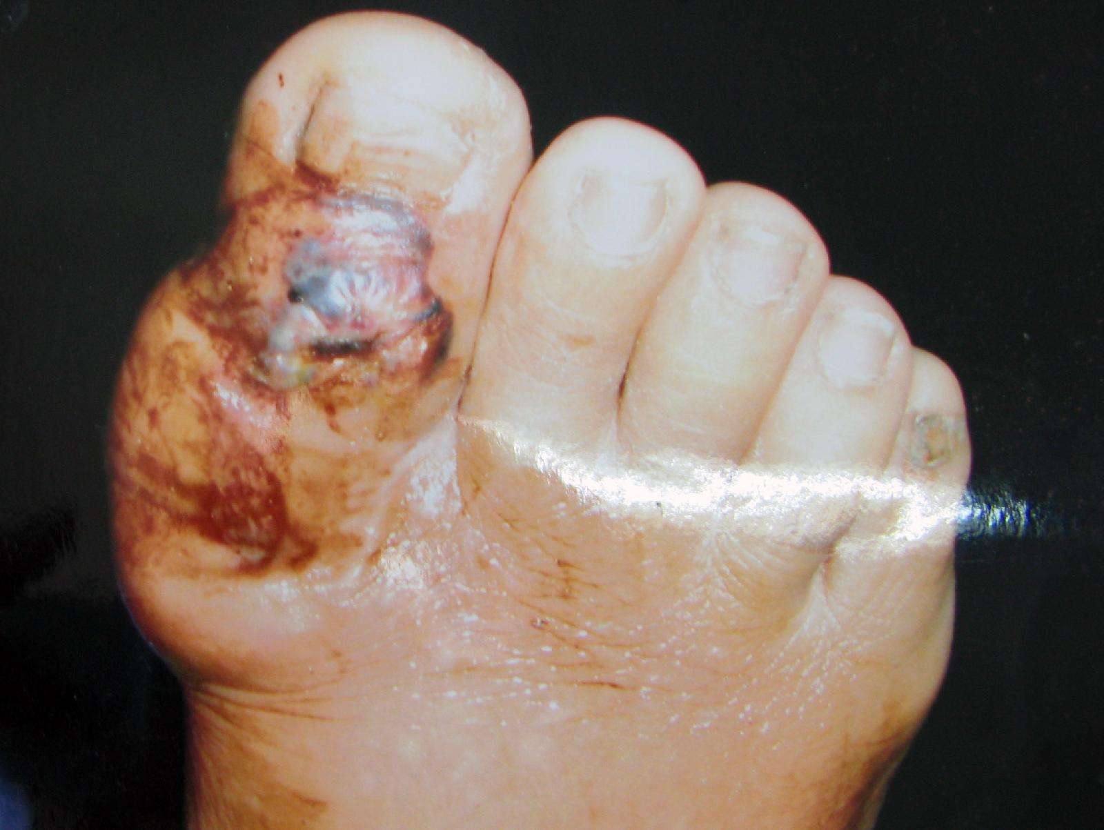 足 拇趾腱鞘囊肿 - 好大夫在线