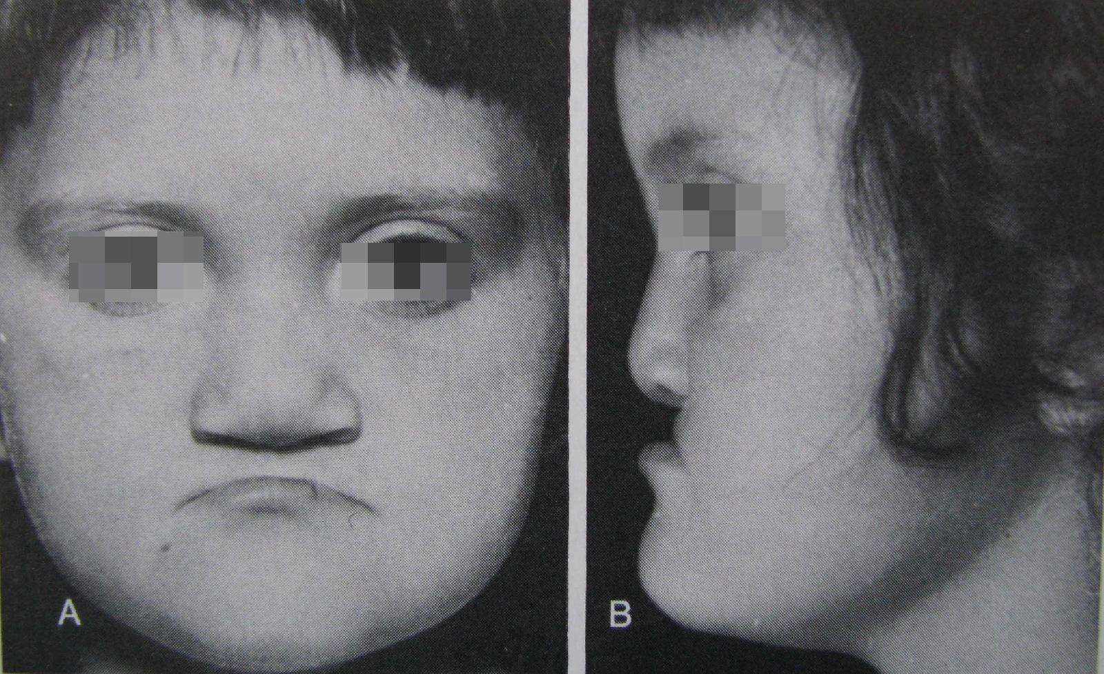 上颌骨缝牵引法是治疗青少年唇腭裂伴上颌骨发育不良患者的最佳选择