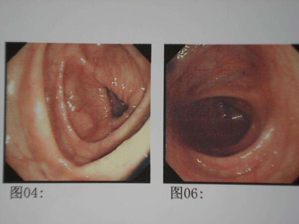 直肠黏膜病变图片