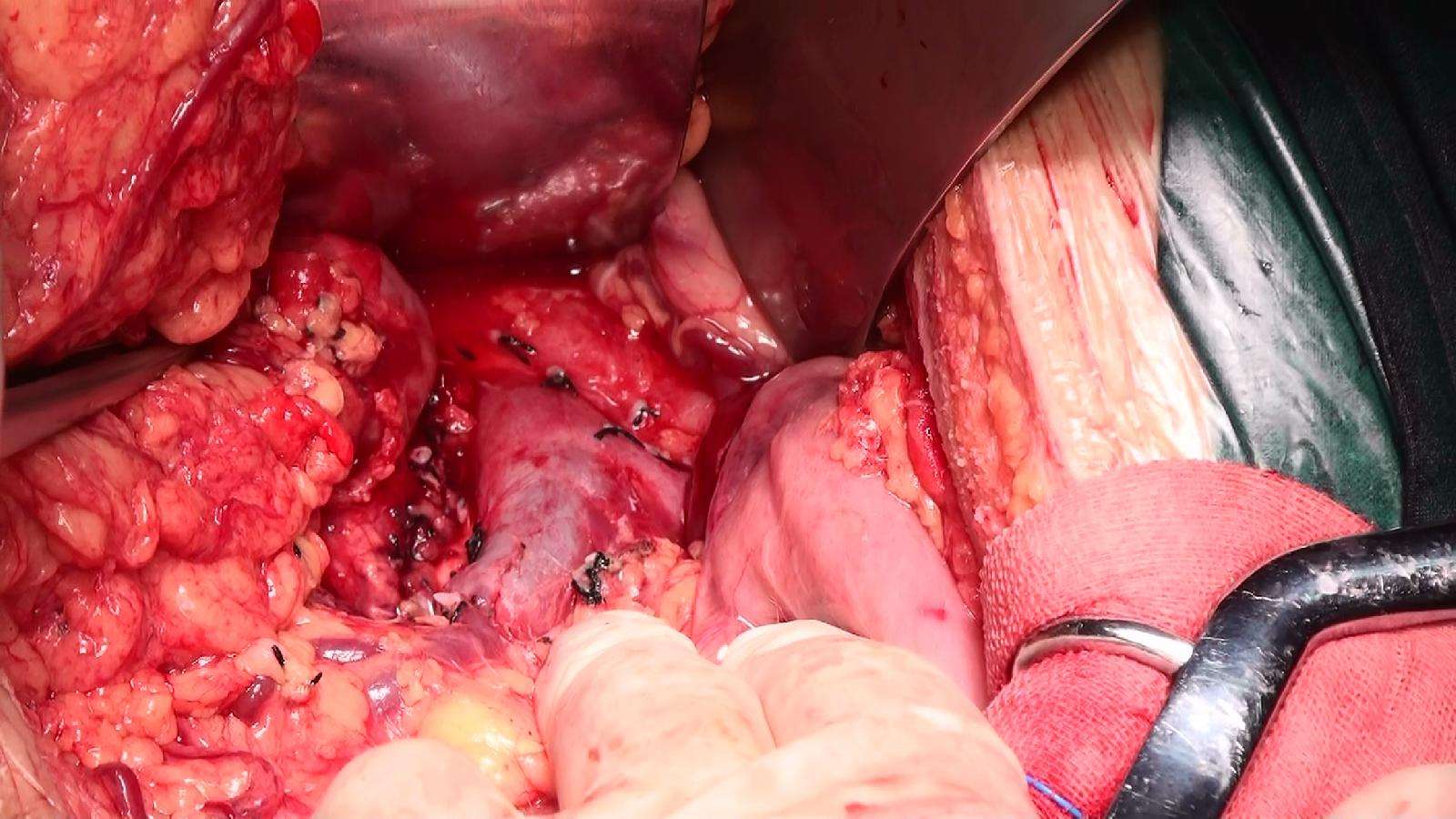 保留十二指肠胰头切除术 - 好大夫在线