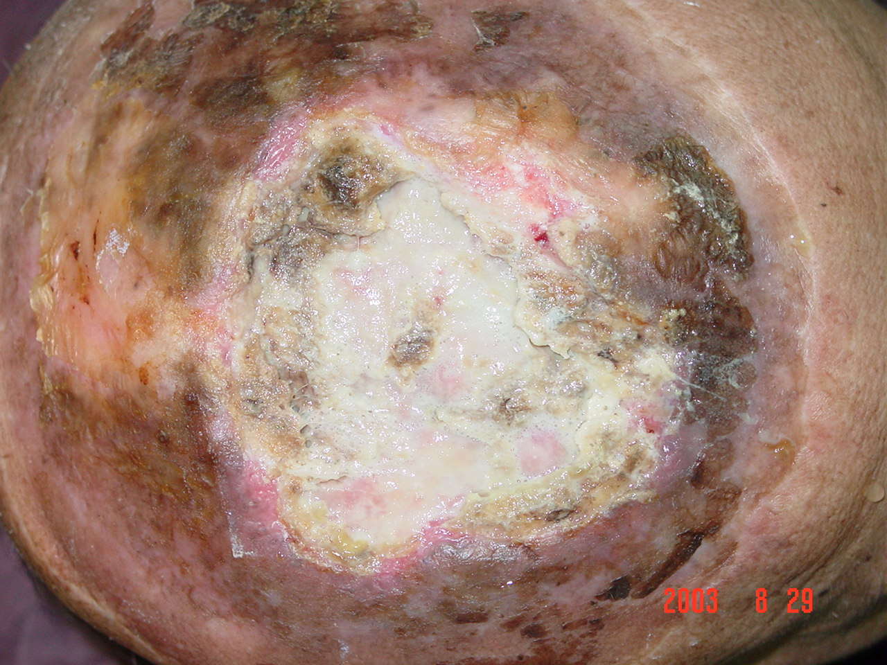 陈旧性烧伤疤痕需防止变异(3) - 好大夫在线