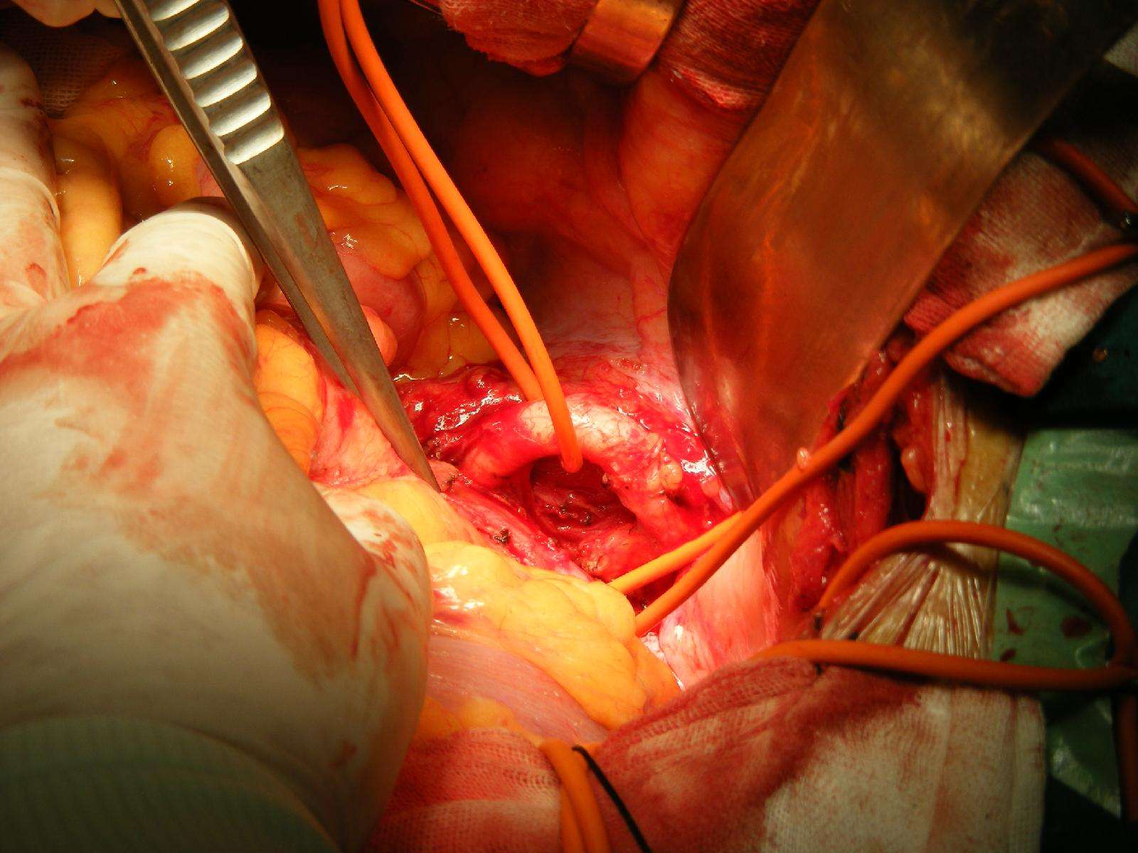 腹主动脉瘤手术中照片 - 好大夫在线