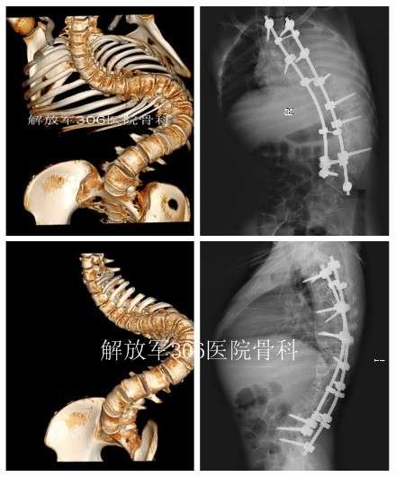 尾椎骨侧弯图片