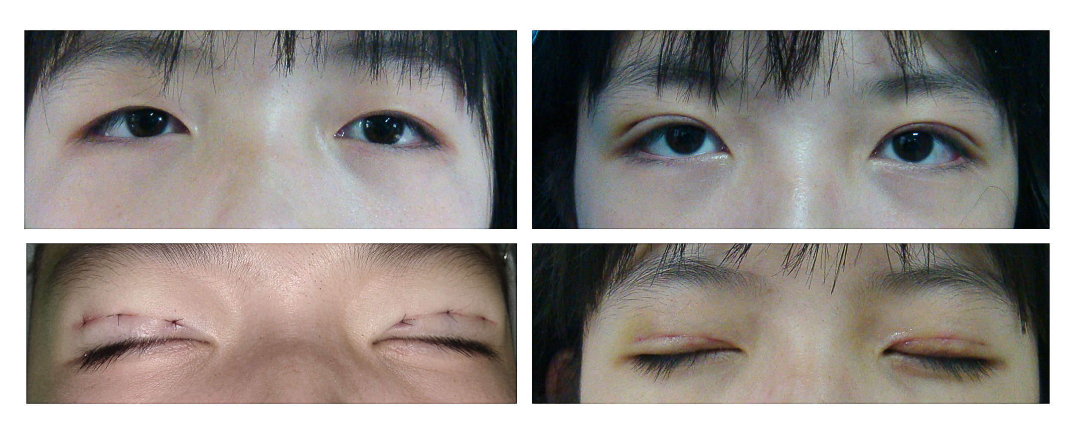 微创重睑术 - 好大夫在线