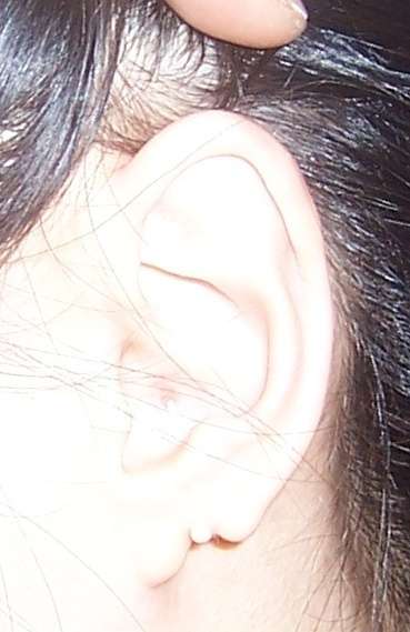 先天性耳垂裂图片