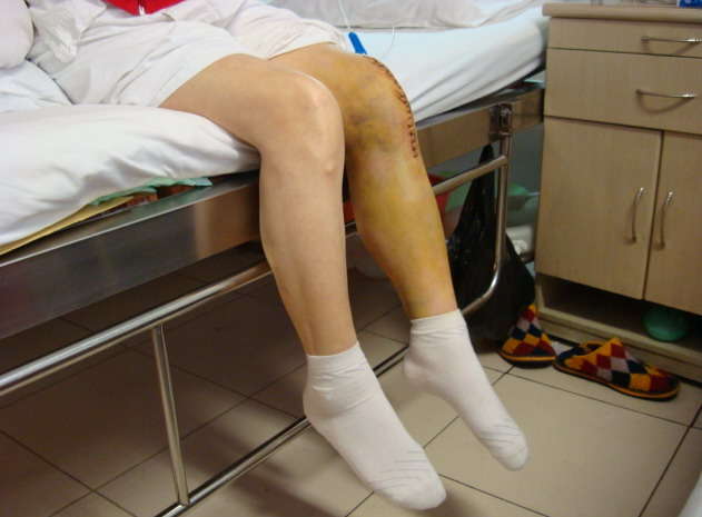 全膝关节置换手术还你一个年轻健康的膝关节