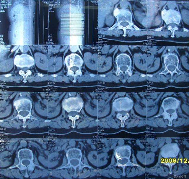 术前胸椎ct显示:t12右前外侧巨大骨质增生