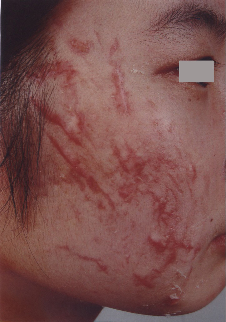 汽油烧伤面部疤痕的早期治疗?