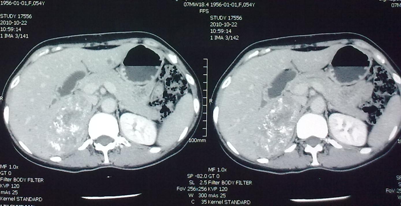 高难度病例荟萃16——微创腹腔镜切除巨大肾上腺皮质癌