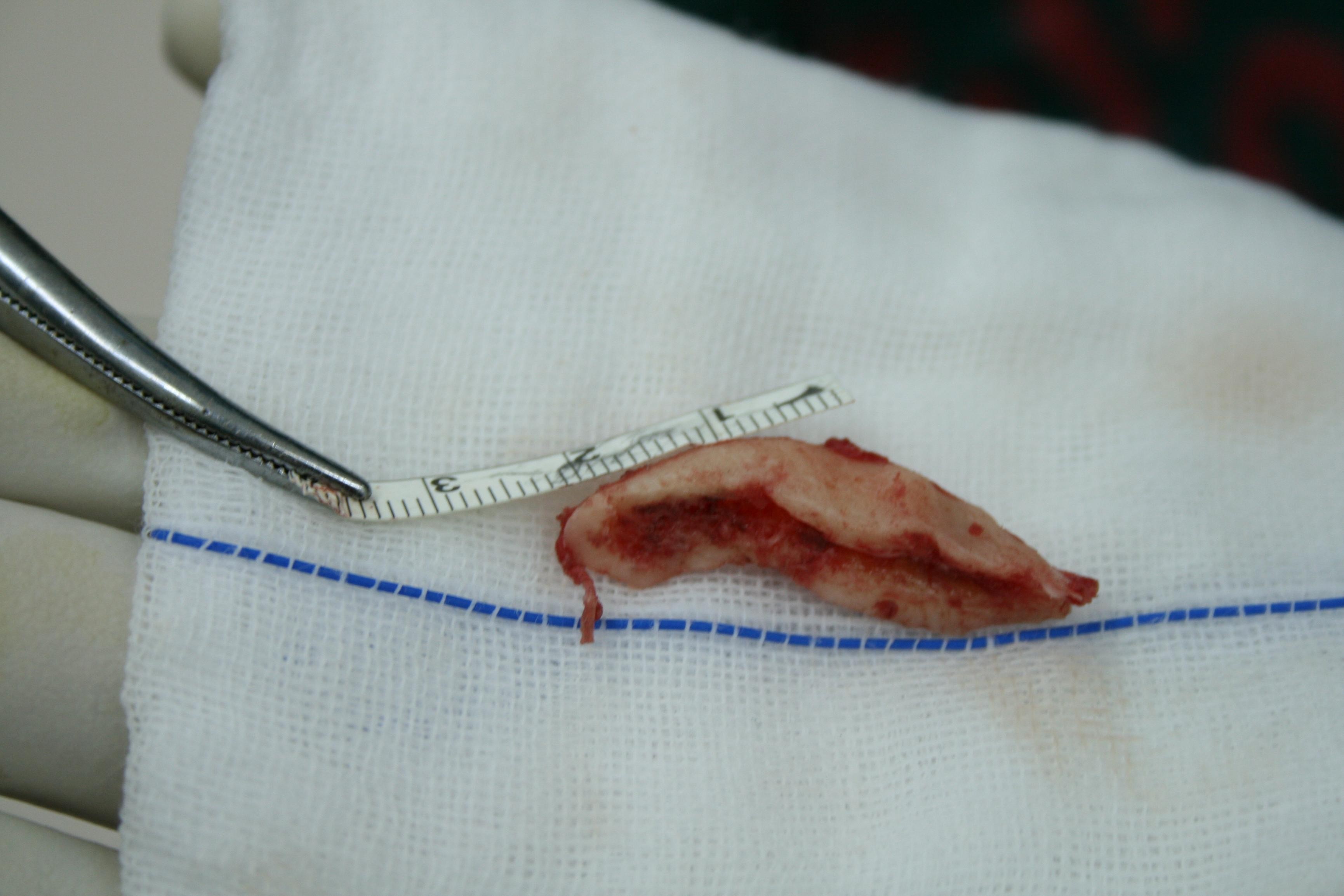 王贝为之失去生命的两块小骨头