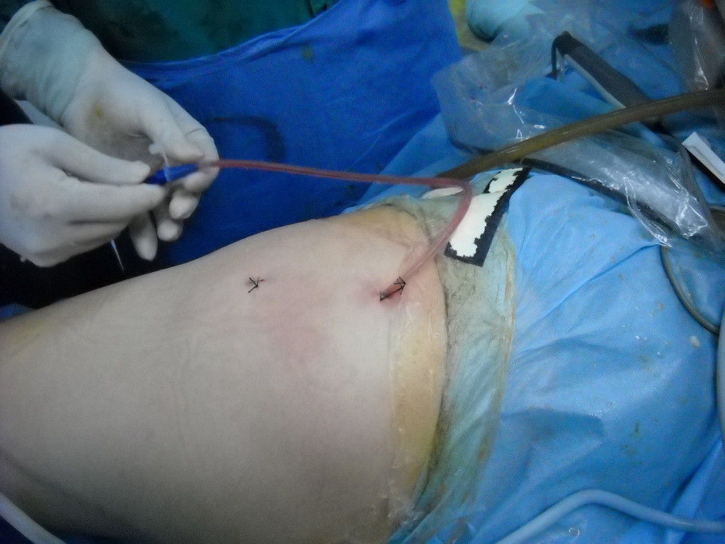 关节镜下臀肌挛缩症治疗 - 好大夫在线