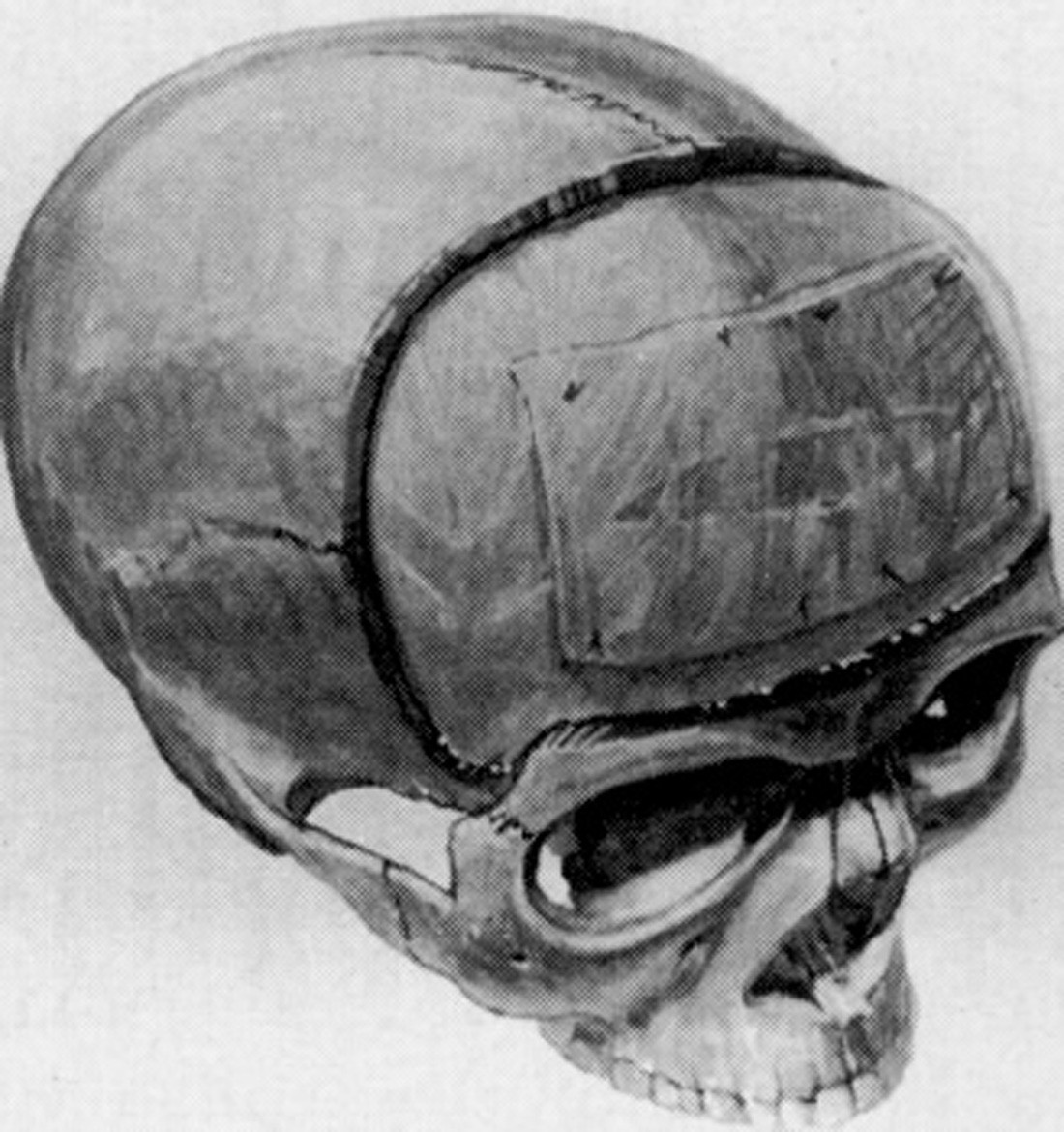 梁玉敏 文章列表 3.2.2双额骨瓣:冠状瓣切口,起止于双侧耳屏前发际内.