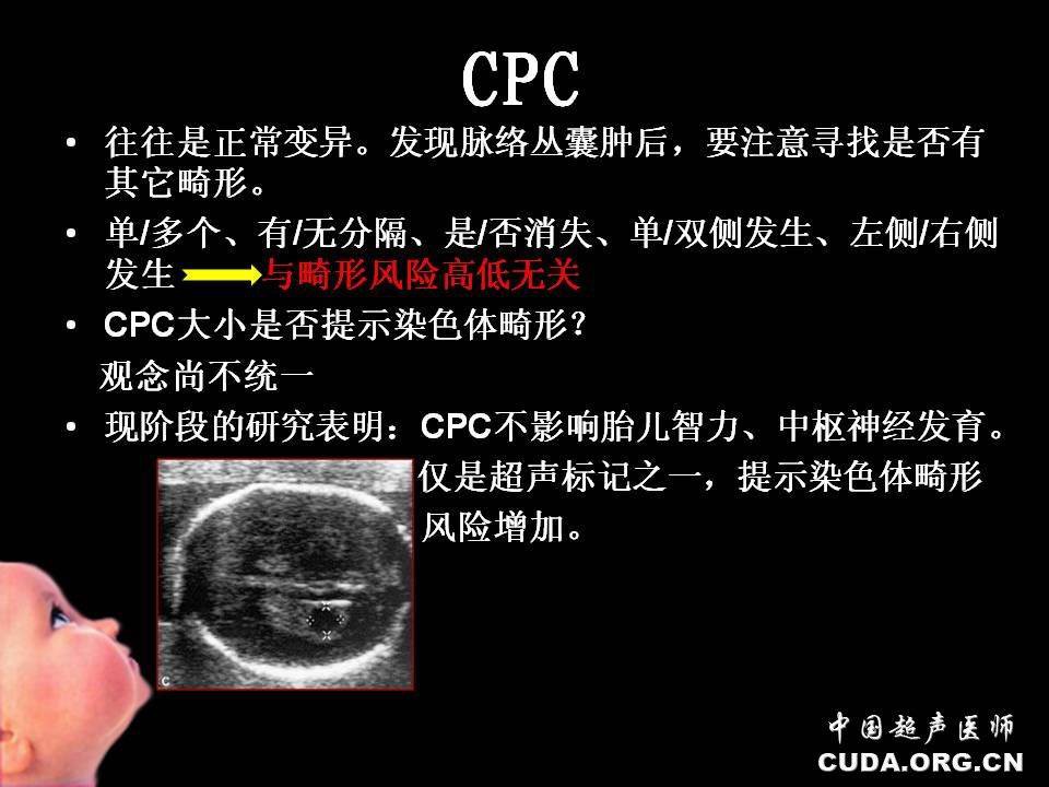 脈絡叢囊腫