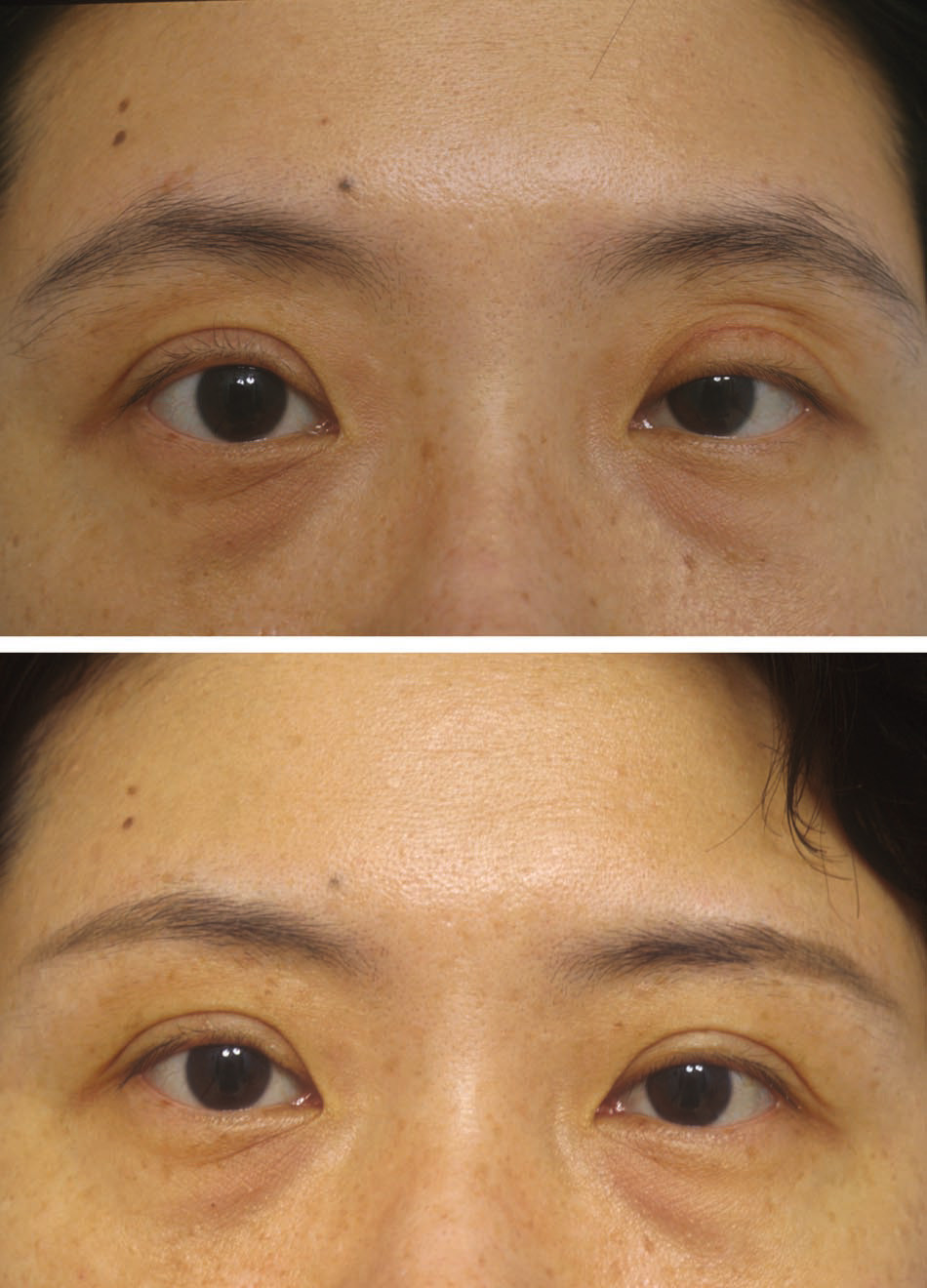 上眼皮凹陷怎么办?_上睑下垂_上睑下垂疾病介绍 - 好大夫在线