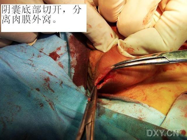 隐睾微创手术伤口图图片