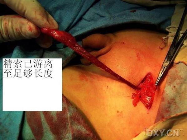 隐睾微创手术伤口图图片