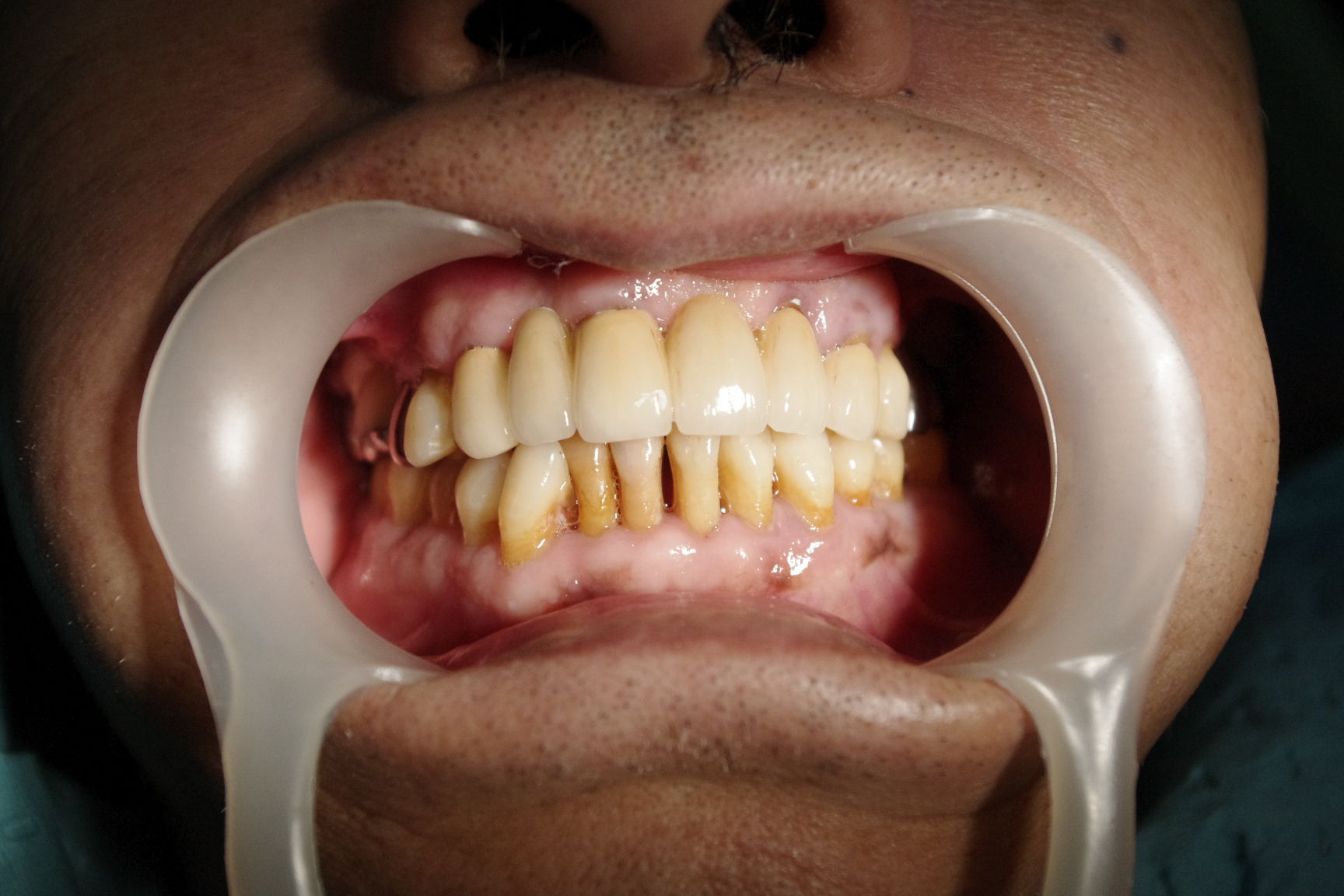 前牙美容修复病例1(牙冠修复法1例) 