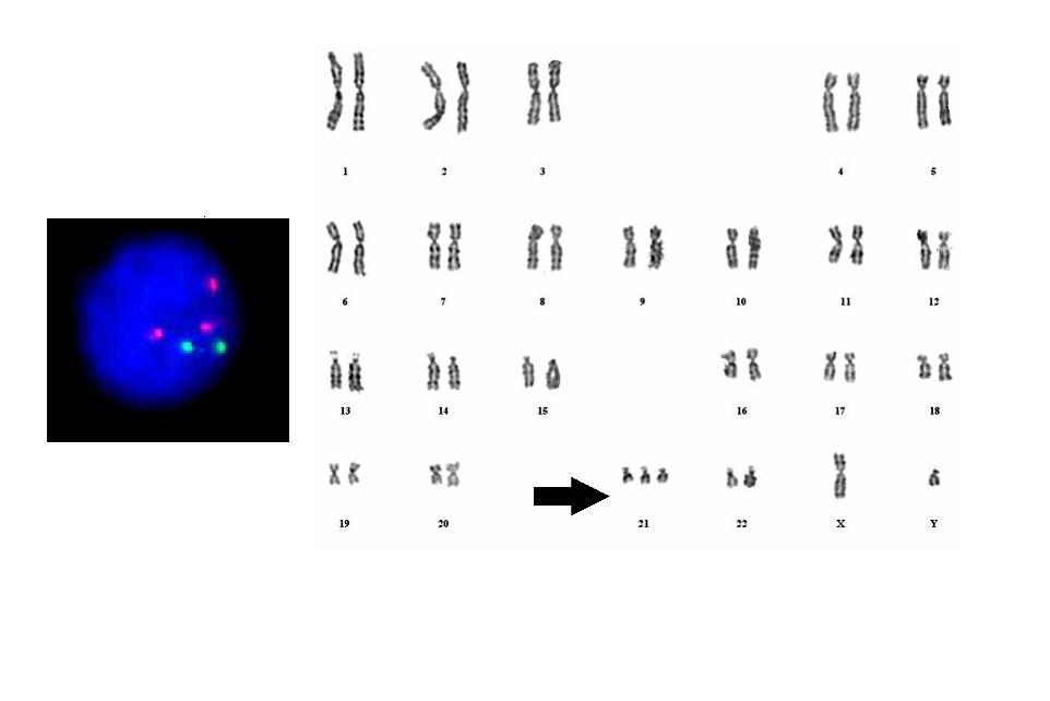 做羊膜腔穿刺手术后能不能尽早知道胎儿是否正常?