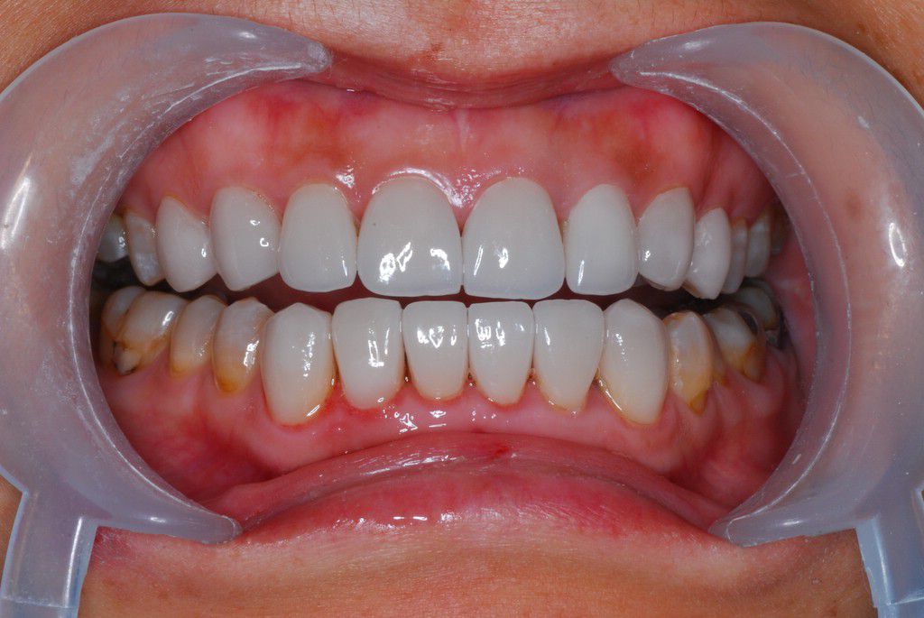 全瓷贴面 美学修复 四环素牙! - 好大夫在线