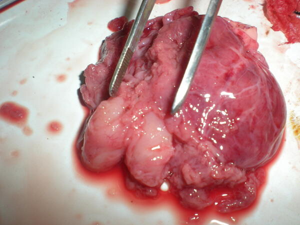 胎儿心脏多发横纹肌瘤一例