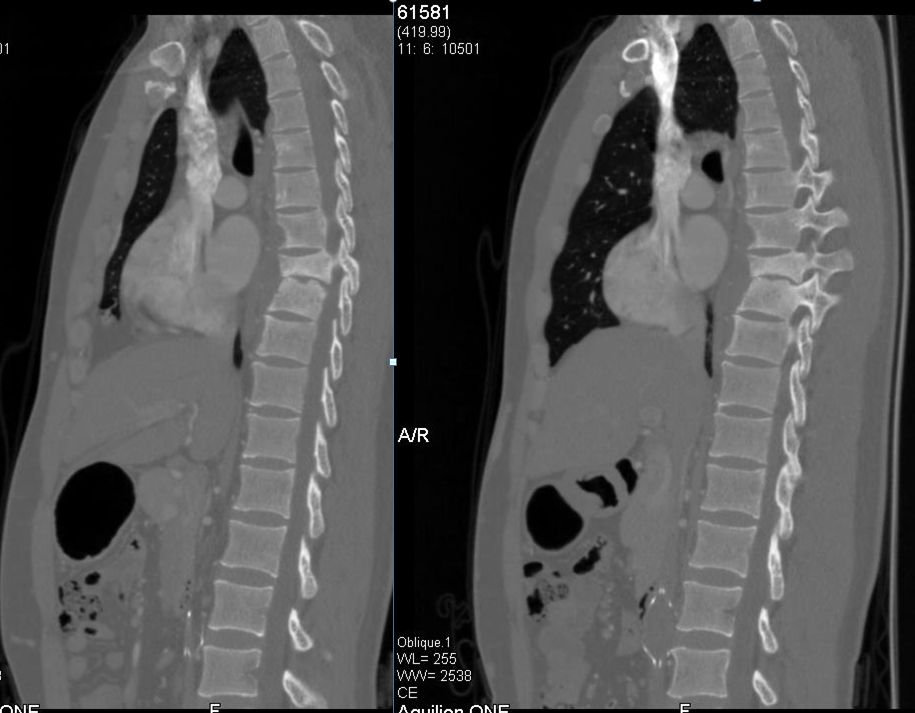 脊柱结核病例13:一例胸椎结核的治疗