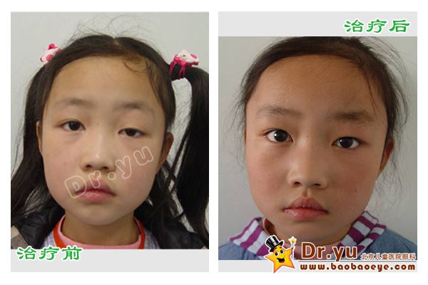上睑下垂术前术后4
